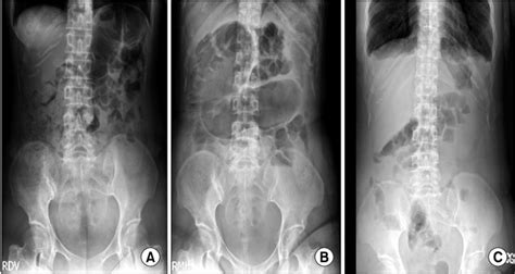 kub abbreviation medical|KUB Radiography .